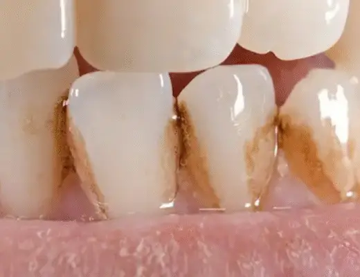 Cómo quitar la mancha de café de los dientes