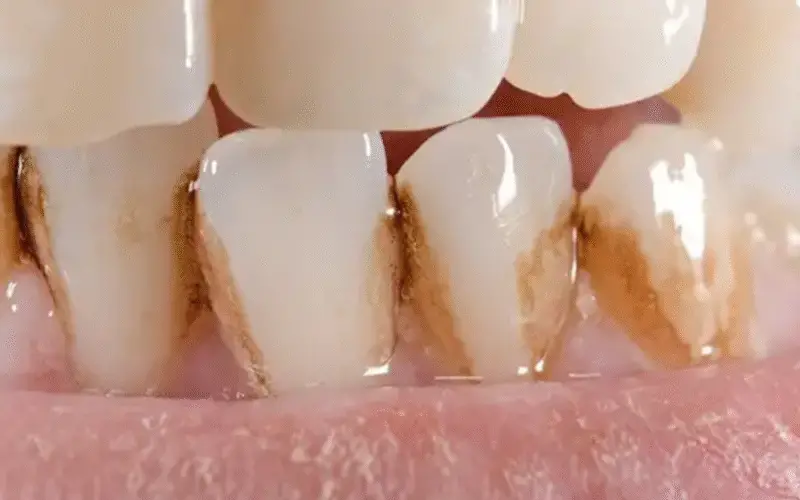 Cómo quitar la mancha de café de los dientes