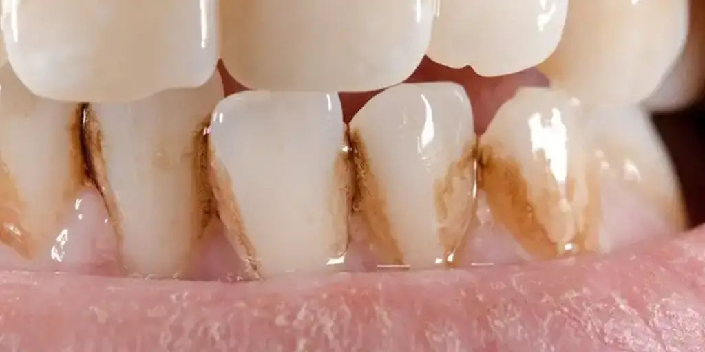Cómo quitar la mancha de café de los dientes